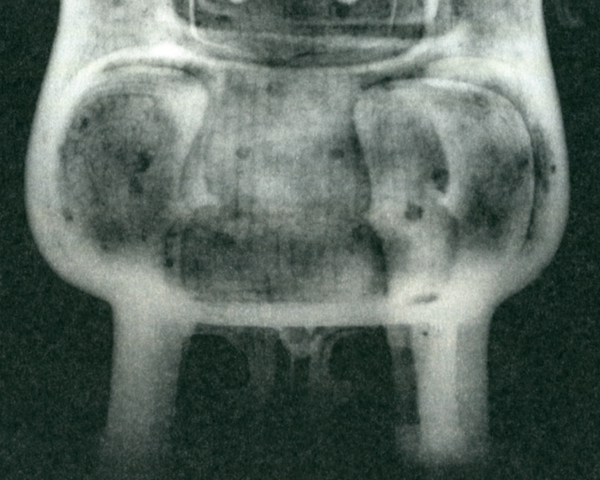 a radiograph of a vessel
